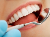 Fatete Dentare Fatete Dentare