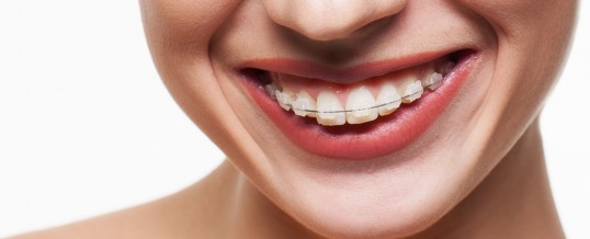 APARATELE DENTARE CREEAZA SAU NU UN DISCONFORT PACIENTILOR?