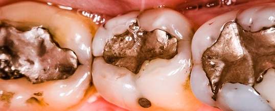 AMALGAMUL DENTAR : UN RISC PENTRU SANATATE?