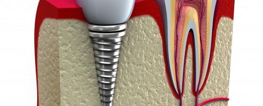 PORCELAIN TOOTH BROKEN AND NEED TO BE REPLACED