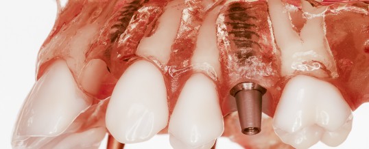 RESPINGEREA IMPLANTULUI DENTAR ?…
