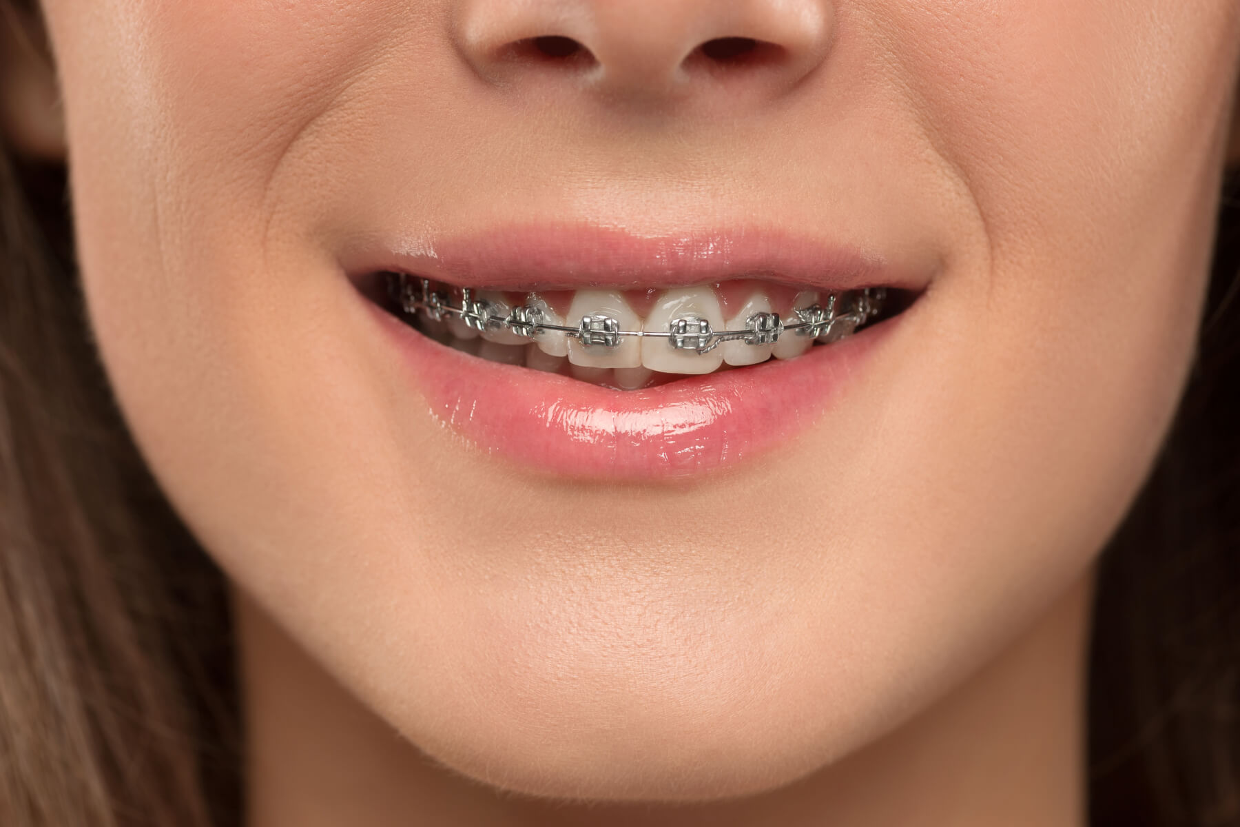 aparat dentar adolescenta