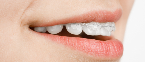 aparat dentar fix safir