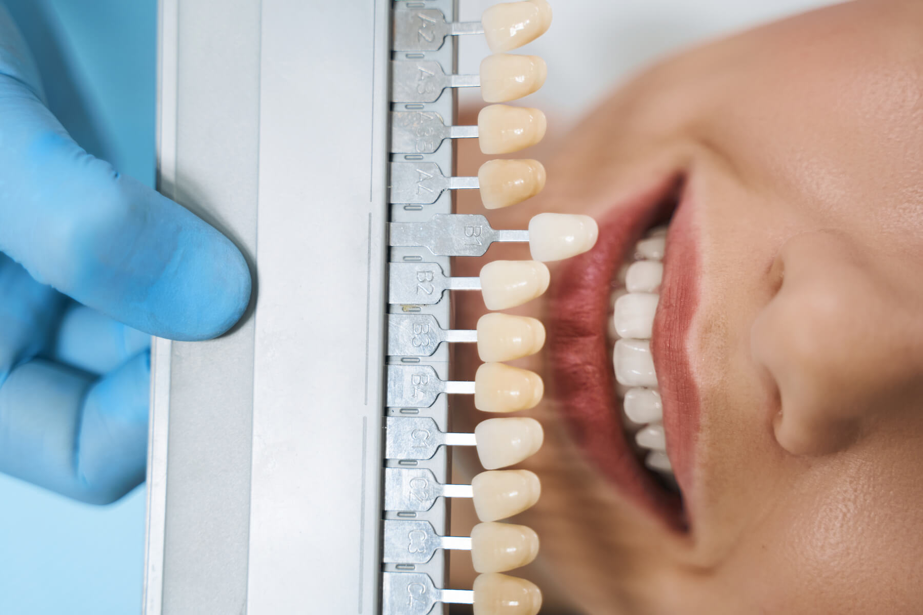 vedere de sus dentist cu fatete